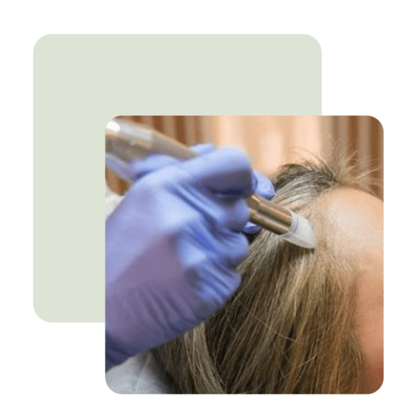 FOLLOW UP SCALP MICRONEEDLING