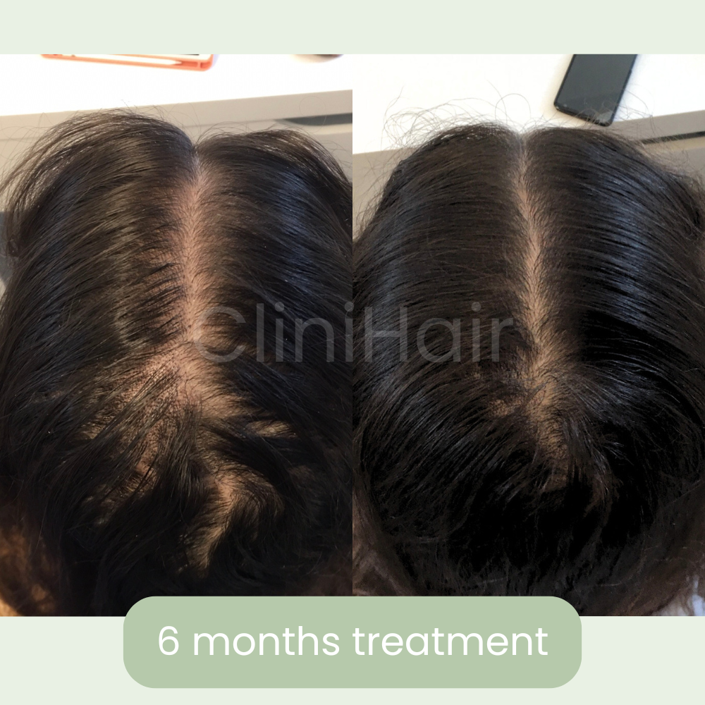 clinihair1