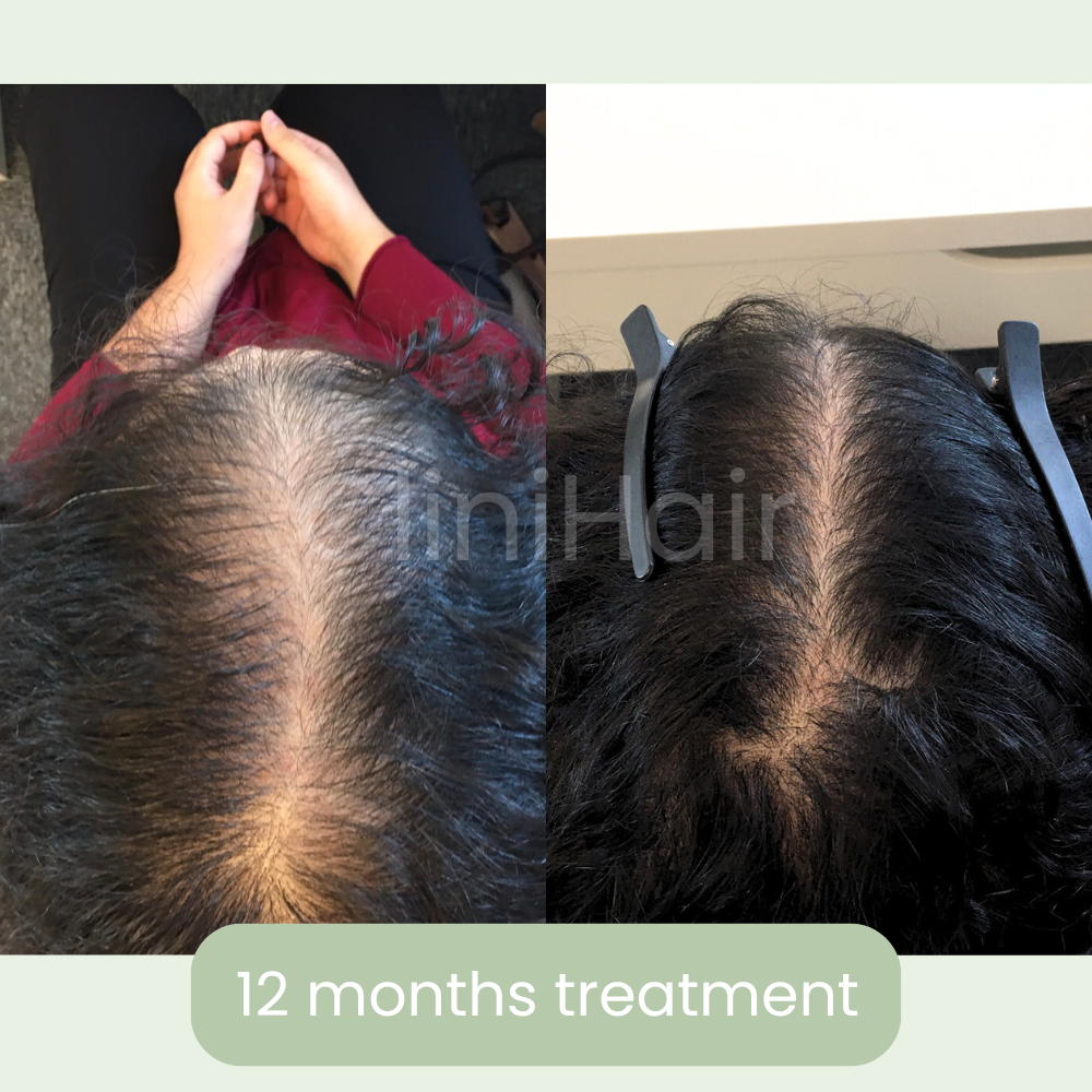 clinihair2