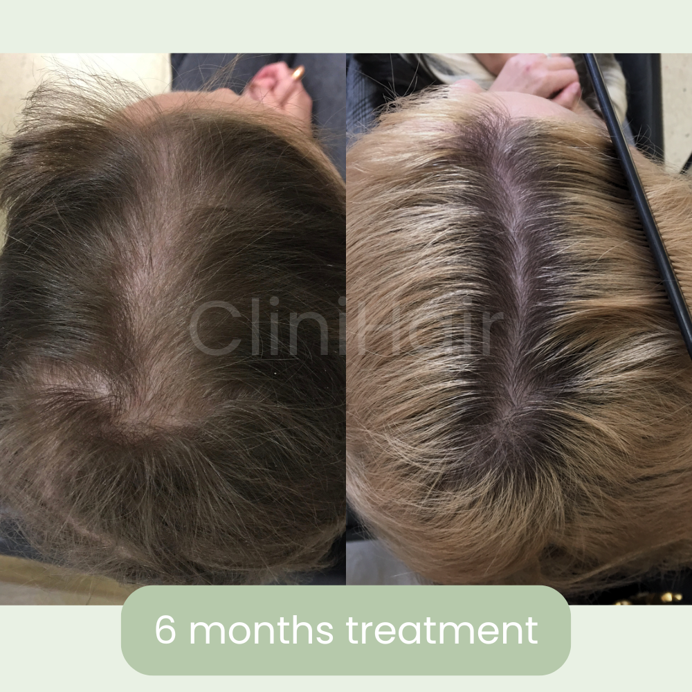 clinihair3